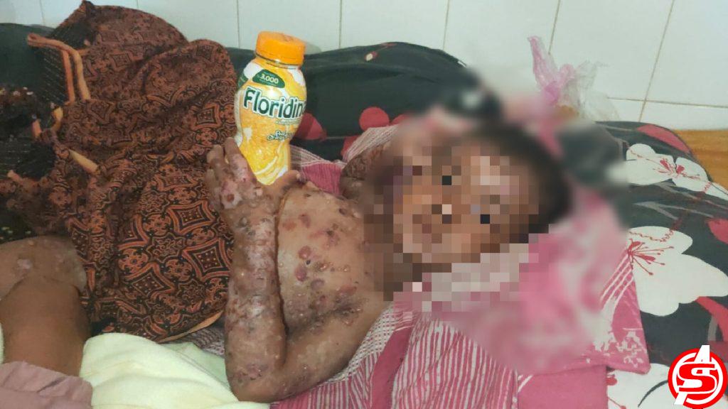 Kapolres Lhokseumawe Bantu Bocah Penderita Penyakit Kulit